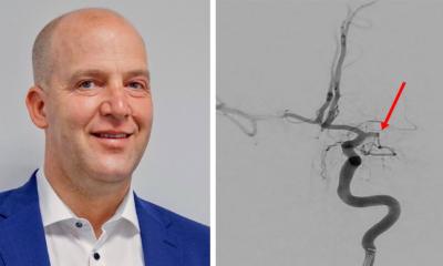 AVC: comment la neuroradiologie sauve la vie
