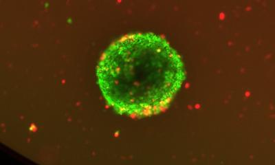 Méningiomes : à haut débit contre les tumeurs cérébrales