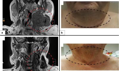 Ostéosarcome extrasquelettique : la pathologie moderne ouvre de nouvelles options de traitement