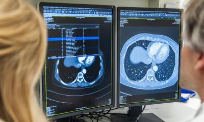 Signal de départ pour le dépistage du cancer du poumon