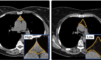 Thymus : l'organe sous-estimé
