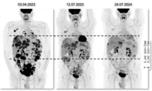 DSRCT : des analyses moléculaires pour de plus grandes chances de traitement