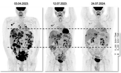 DSRCT : des analyses moléculaires pour de plus grandes chances de traitement