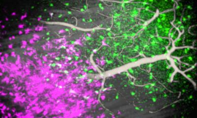 Glioblastome : l’interaction immunitaire fournit des indices sur de nouvelles thérapies