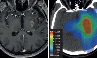 Imagerie des récidives de glioblastome : TEP ou IRM ?