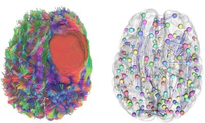 Les glioblastomes détournent les réseaux cérébraux