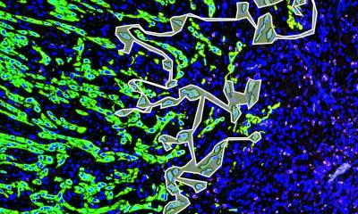 Tumeurs de la tête et du cou : les « bourgeons » présentent une croissance agressive
