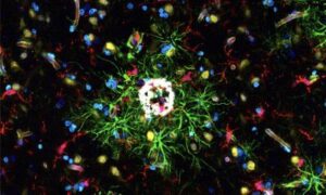 Alzheimer : la découverte des cellules immunitaires ouvre de nouvelles perspectives