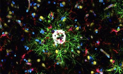 Alzheimer : la découverte des cellules immunitaires ouvre de nouvelles perspectives