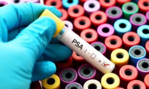 Cancer de la prostate : le dépistage du PSA pourrait réduire la mortalité