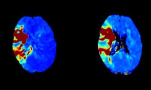 Collaboration dans le traitement de l&rsquo;AVC via CBCT-P