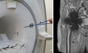 Des implants en IRM ? Pourquoi, sûrement !