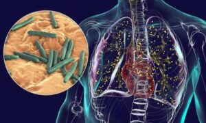 Diagnostiquer la tuberculose à l&rsquo;aide d&rsquo;un prélèvement de langue