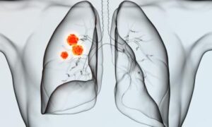Cancer du poumon directive S3 : nouvelles recommandations sur l’immunothérapie et l’opérabilité