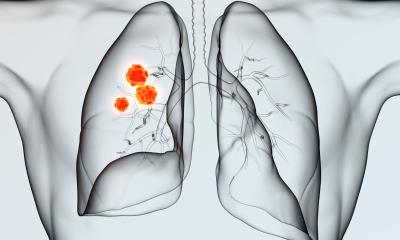 Cancer du poumon directive S3 : nouvelles recommandations sur l’immunothérapie et l’opérabilité