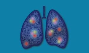 Cancer du poumon : un interrupteur métabolique incite le système immunitaire à attaquer les cellules tumorales