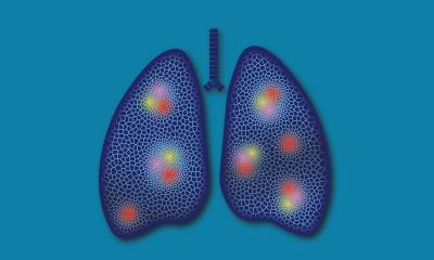Cancer du poumon : un interrupteur métabolique incite le système immunitaire à attaquer les cellules tumorales