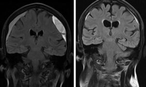 Hématome sous-dural chronique : moins de rechutes grâce à l&rsquo;intervention par cathéter