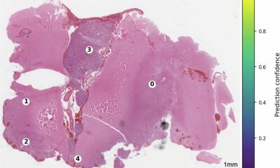 Tumeur cérébrale : l’IA délivre un diagnostic en quelques minutes
