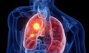 Un interrupteur « réveille » le cancer du poumon et le rend vulnérable
