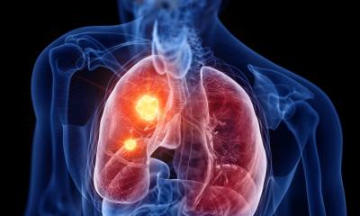 Un interrupteur « réveille » le cancer du poumon et le rend vulnérable