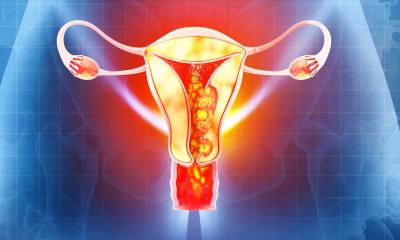 Un traitement mieux adapté au risque pour le cancer de l'endomètre