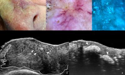 Cancer de la peau du visage : l’échographie regarde sous la surface