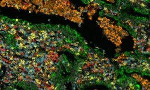 Cancer du poumon NSCLC : les cellules stromales prédisent la survie à long terme