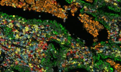 Cancer du poumon NSCLC : les cellules stromales prédisent la survie à long terme