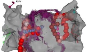 Cardioneuroablation – nouvelle option de traitement pour les battements cardiaques lents