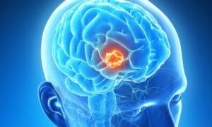 Étude : Le glioblastome défie les radiations à haute dose