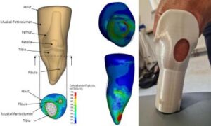 Impression 3D et procédés numériques : solutions durables pour les prothèses