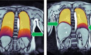 L’IRM en temps réel détecte précocement les troubles de la déglutition et de la respiration