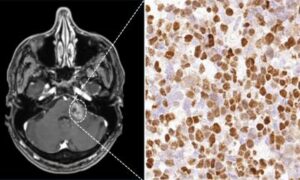 Le virus Epstein-Barr affecte les lymphomes primaires du SNC