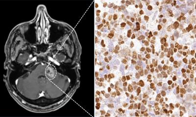Le virus Epstein-Barr affecte les lymphomes primaires du SNC