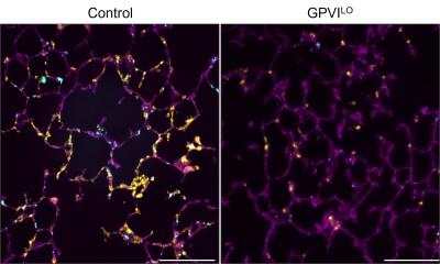 Prévenir la thrombose sans augmenter le risque de saignement