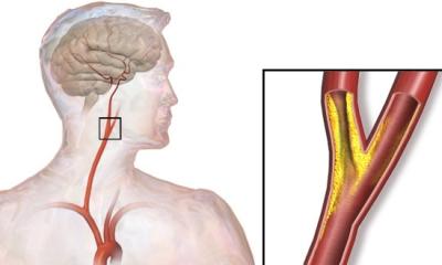 Sténose carotidienne : les médicaments ne remplacent pas toujours la chirurgie