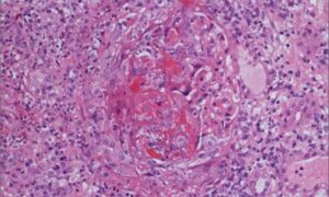 Vascularite : avec de meilleurs biomarqueurs pour une thérapie sur mesure
