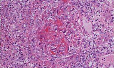 Vascularite : avec de meilleurs biomarqueurs pour une thérapie sur mesure