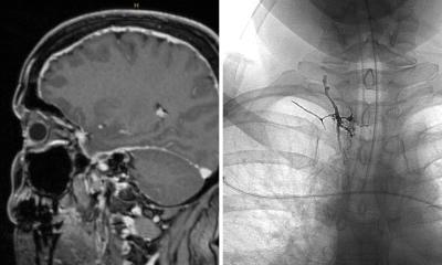 Fuites de liquide céphalo-rachidien dans le cerveau : la neuroradiologie aide au diagnostic et au traitement