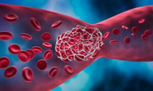 L&rsquo;adénovirus provoque de rares caillots sanguins chez les enfants