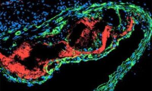 L&rsquo;athérosclérose est une maladie auto-immune