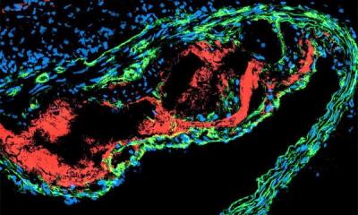 L'athérosclérose est une maladie auto-immune