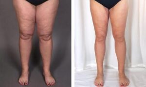 Lipœdème : une étude montre les avantages de la liposuccion