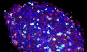 Comment les glioblastomes paralysent le système immunitaire