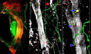 LQT2 : Nouvelles découvertes sur les arythmies cardiaques héréditaires