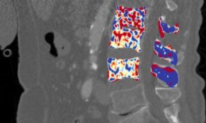 Ostéoporose : analyse CT utilisant l’IA pour une meilleure détection précoce