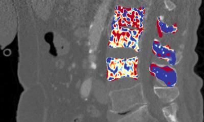 Ostéoporose : analyse CT utilisant l’IA pour une meilleure détection précoce